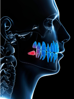 A 3D anatomical side-view diagram of a human skull highlighting an impacted wisdom tooth in red, showing it growing horizontally against the adjacent molar.
