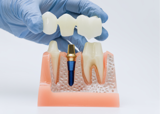 A dental model demonstrating a bone graft site with an implant post and a custom-fitted bridge being placed to restore missing teeth.