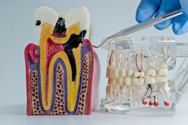A cross-section anatomical model of a human tooth showing deep black decay reaching the red inner pulp and root canals, alongside a clear dental model being examined with a probe.