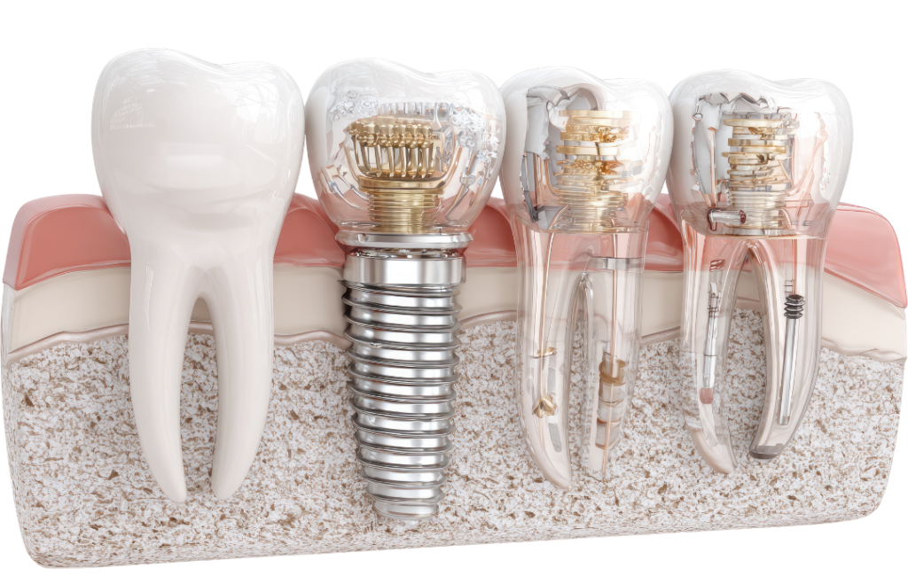 A 3D anatomical diagram showing the structure of a dental implant, including the titanium post integrated into the jawbone and the porcelain crown restoration on top.