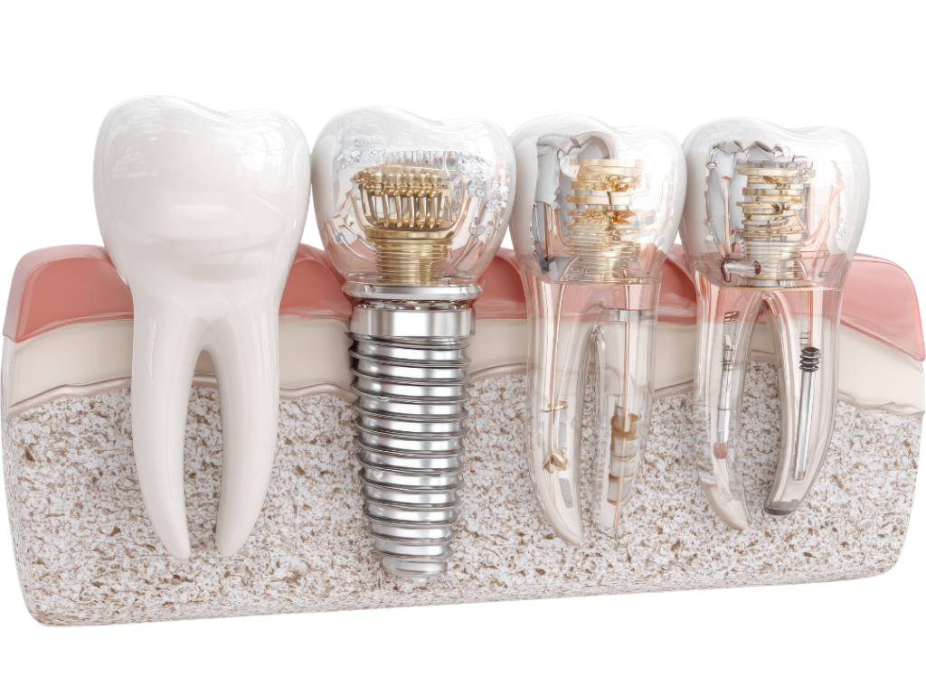 A 3D diagram illustrating the All-on-4® dental implant concept, showing four titanium implants supporting a full arch of artificial teeth within the jawbone.